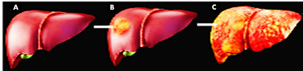Fig. 4 A=human liver in normal shape, B= infected liver by AFs in initial stage, C= completely worn-out liver after AFs infections 